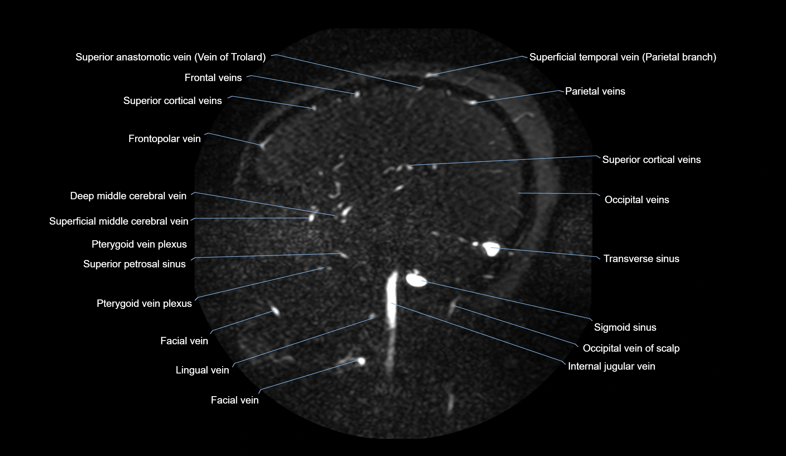 MRV brain sagittal anatomy 3T MRI images -img-01015-00025.webp